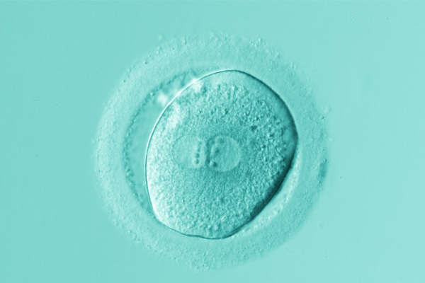 What is ICSI? When is it the best fertility option, and why?